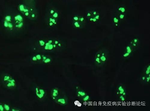抗SSA抗体强阳性而ANA荧光法阴性结果有何临床意义？是检测结果不可靠还是另有玄机？ ...