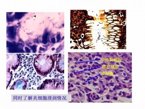 陈烨教授：幽门螺杆菌的检测方法评价（上）