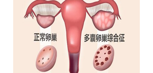 多囊卵巢综合征诊治内分泌专家共识（2018）（上）