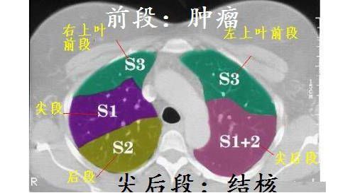 CT诊断肺结核宝典来了，这个解读我给满分！