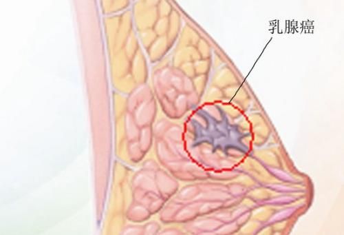 JAMA：乳腺癌转移更易发生在女性生育后10年内