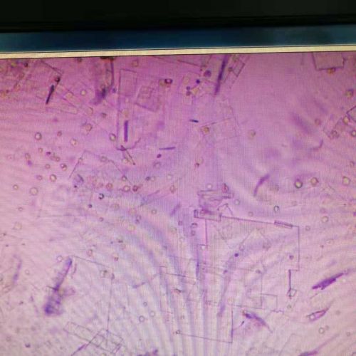 罕见！胸水中竟然发现胆固醇结晶
