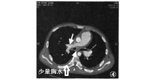 胸腔积液宝典：不知道这些病因，你拿什么鉴别诊断！