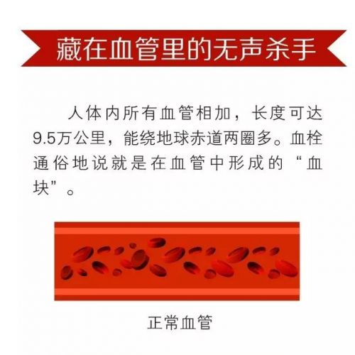 血栓最容易“栓”住5类人，牢记这个口诀能救命！
