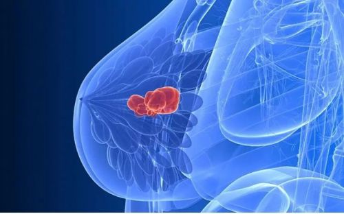 乳腺癌复发早知道，血液检测不可少