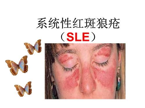 狼疮抗凝物（LA）检测