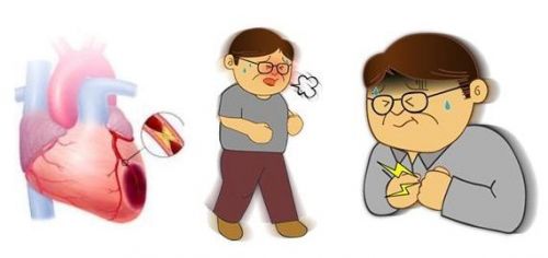 心肌梗死（上）概述