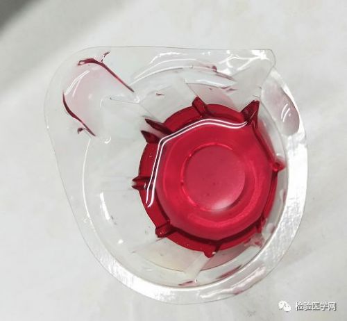 她半夜突发尿血、便血，万万没想到化验结果竟然是？
