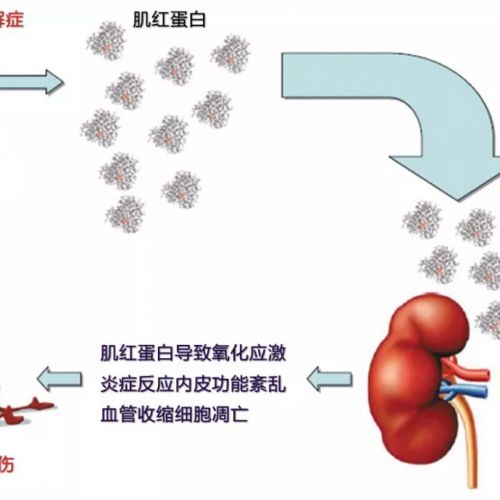 肌红蛋白： 过时或仍具有临床价值？