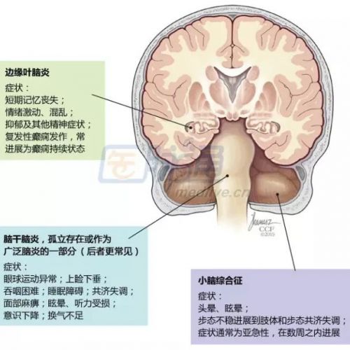 自身免疫性脑炎：掌握要点并不难