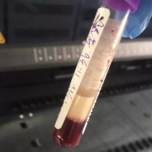 抽血的时候，血液颜色不正常是为何？抽血前能吃饭、能喝水吗？ ...