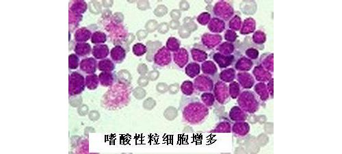 嗜酸性粒细胞高？——别想得太简单