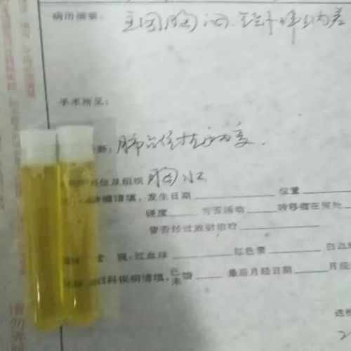 一个胸水常规发现肿瘤细胞的病例