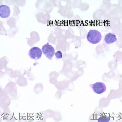 血液系统疾病诊断思路图解病例之AML部分分化型