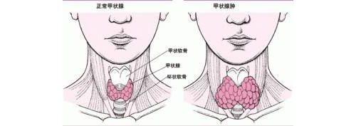 与左甲状腺素的爱恨关系