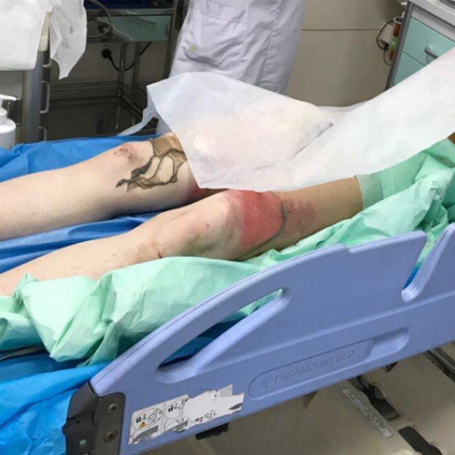 感染指标结果不会跟临床沟通？看完这个烧伤面积达 80% 的感染病例就全搞清楚了 ... ...