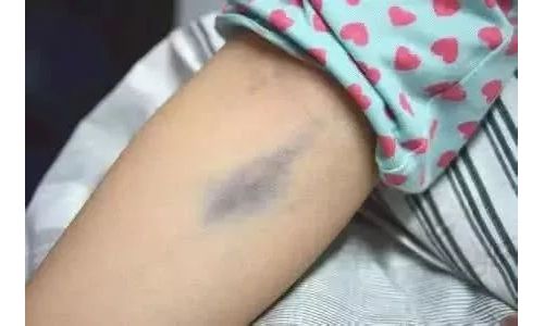 为什么抽了个血手臂上淤青了好几天？是不是抽血抽得不好造成的？ ...