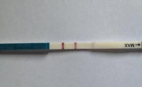 导致尿HCG假阳性的原因分析