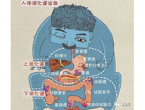 大便带血，不是痔疮就是肠癌？没那么简单！