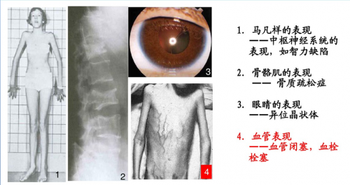 一个没有感情的血管“杀手”——同型半胱氨酸