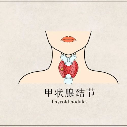 甲状腺结节是良是恶？检验医生来审判！