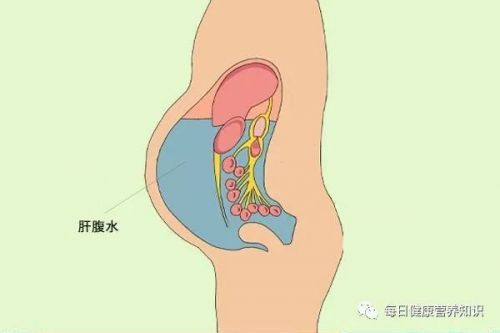 肝癌来临，大小便先知？