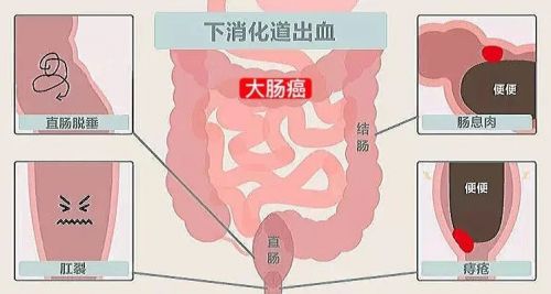 拉完粑粑看一眼，等于做次小体检！