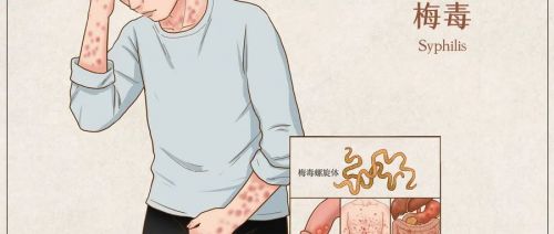 新生儿得梅毒！为什么？怎么办？