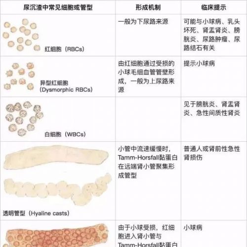 检验项目 | 尿沉渣管型的分类及临床意义