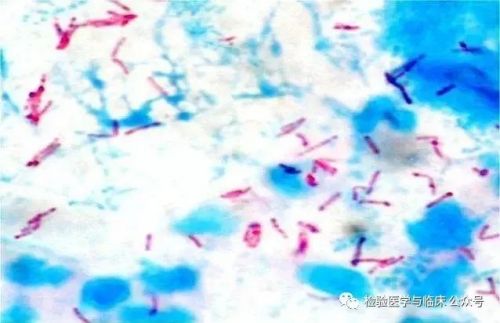 结核分枝杆菌感染与细胞因子的关系