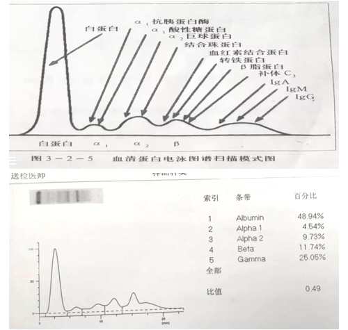 D-二聚体异常升高，虚惊一场！