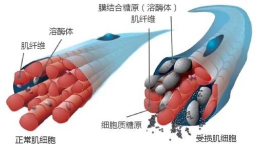 4.15 国际庞贝病日 | 数百万换一年寿命，庞贝病患者的困境与无奈 ...
