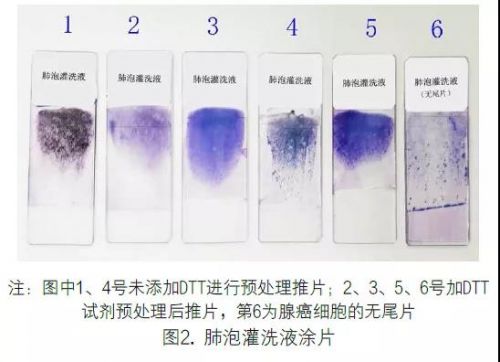 支气管肺泡灌洗液细胞形态学检验中国专家共识（2020）解读
