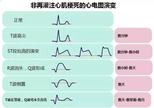 巧学心电图诊断思路及技巧
