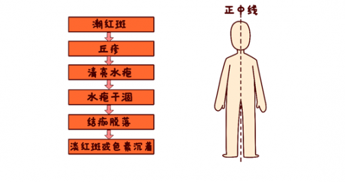 揭开带状疱疹传说中的面纱