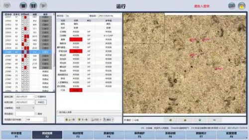 隐匿的凶手——肝内胆管扩张的元凶