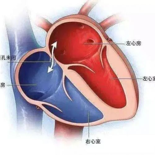 疾病百科全书：心肌梗塞和急性冠状动脉综合征