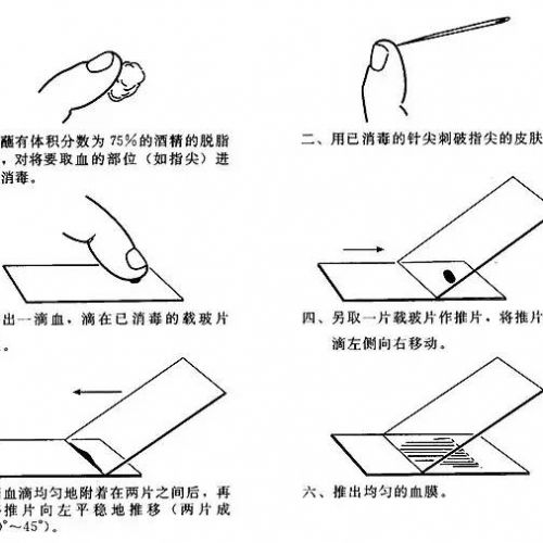 如何制作一张满意的血涂片