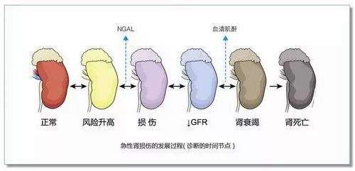 NAGL急性肾损伤的早期诊断标志物！