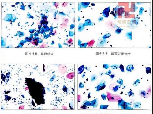 阴道分泌物检查的临床意义
