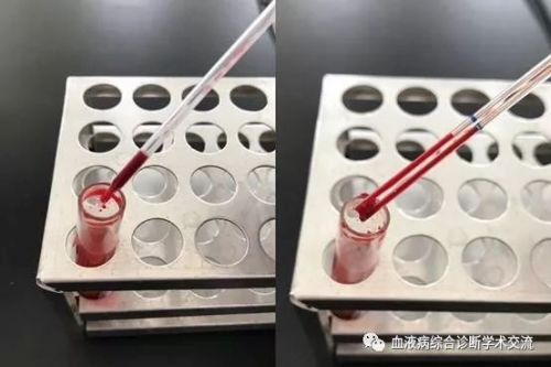 血液湿片，2秒辨真假血小板减少