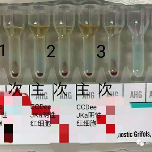 太难了！混合抗体的交叉配血为何如此复杂