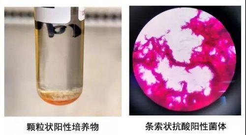 方法多？诊断难？Xpert MTB/RIF实现结核分枝杆菌的精准快检