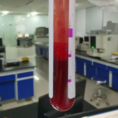 有泡沫的血液标本，你注意了吗？