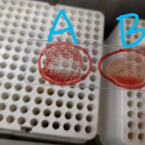 【灵魂拷问】工作中所有的冷凝集都被我们筛出来了吗?