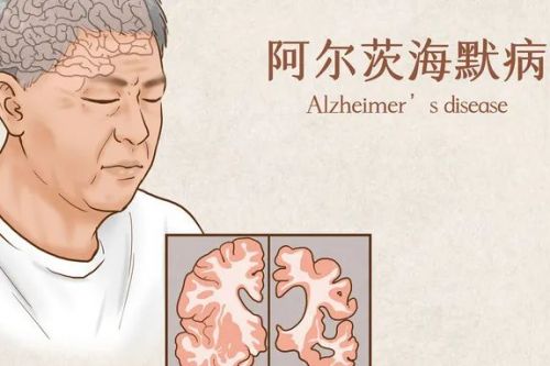 这可不是老糊涂！阿尔茨海默病的早期信号一定要知道