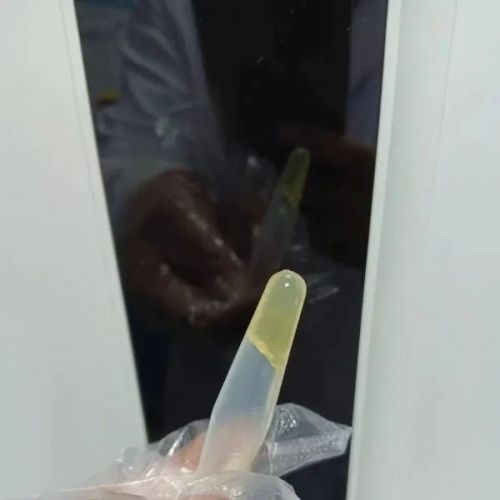 胶冻样尿液标本，你见过吗？