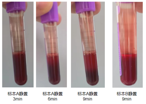 血红蛋白完美“消失”，最终原因99%的人根本想不到！
