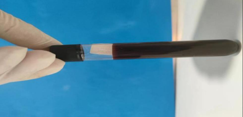 70 岁老人肺部惊现大洞，穿刺流出一袋「墨汁」
