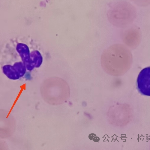 外周血惊现“死亡小体”！